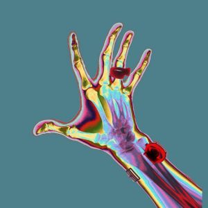 X-ray-hand2