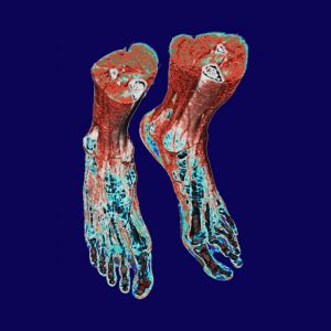 X-ray-right-feet